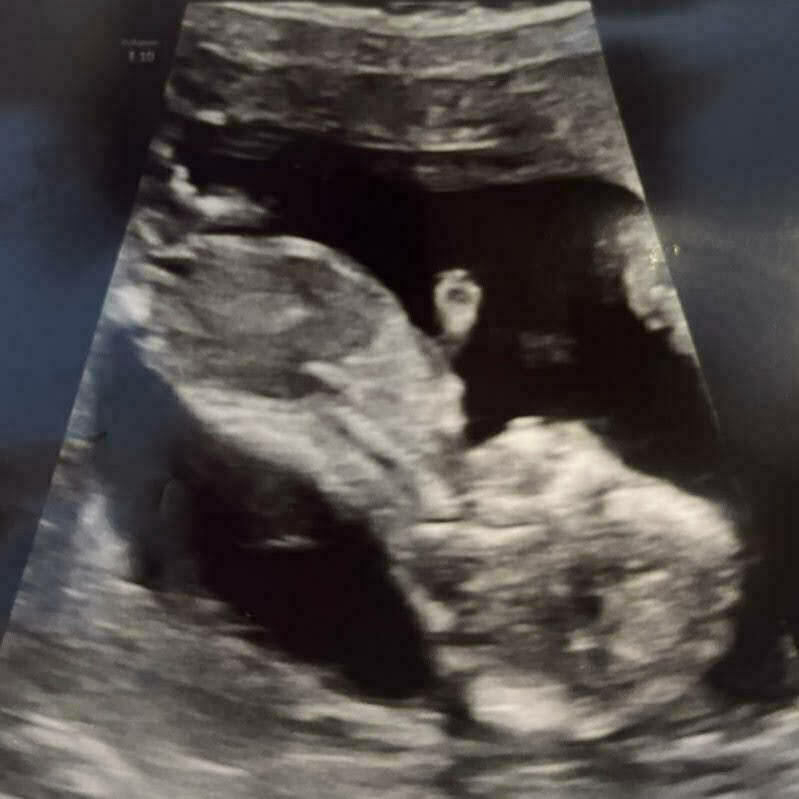 Auto-generated description: An ultrasound scan showing a developing fetus in the womb.